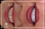 Hollywood smile - 20 Years Warranty With 50% Off