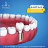 Dental implant price in Ras Al Khaimah