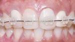 orthodontic without painful