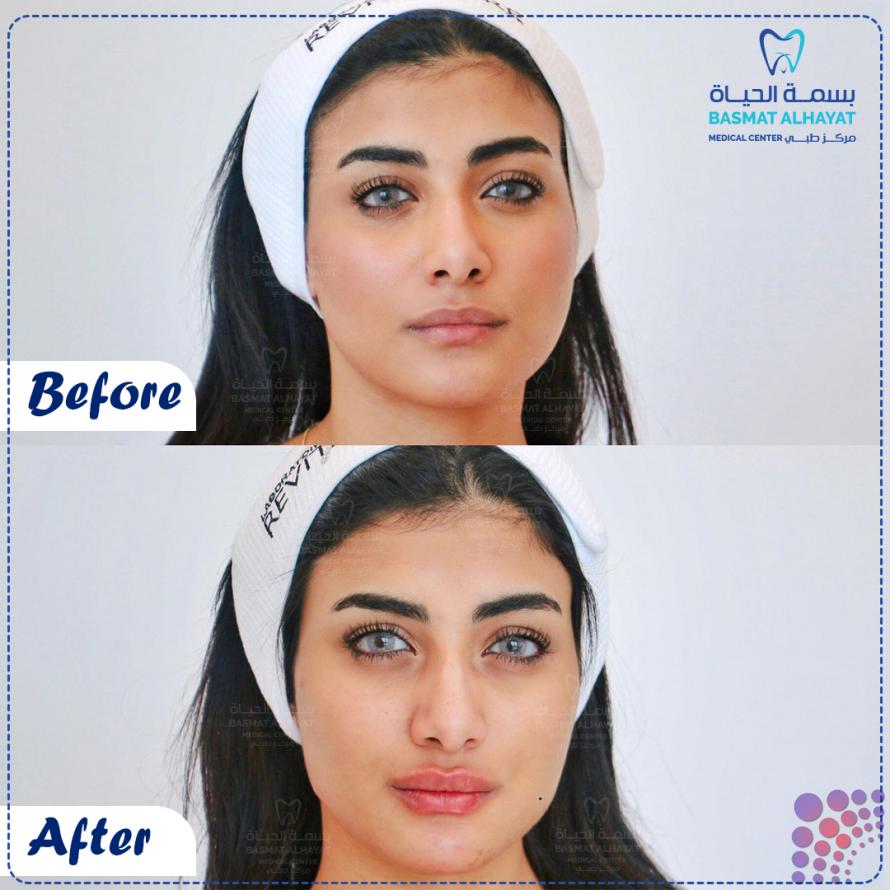 The best beauty center for profile injections in the UAE