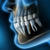 Dental implants in Sharjah