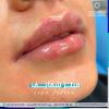 What do I do after injecting lip fillers