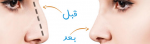 The best nose reduction in Ajman